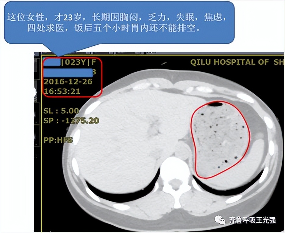 胃食管反流病的偏方,胃食管反流病最新治疗