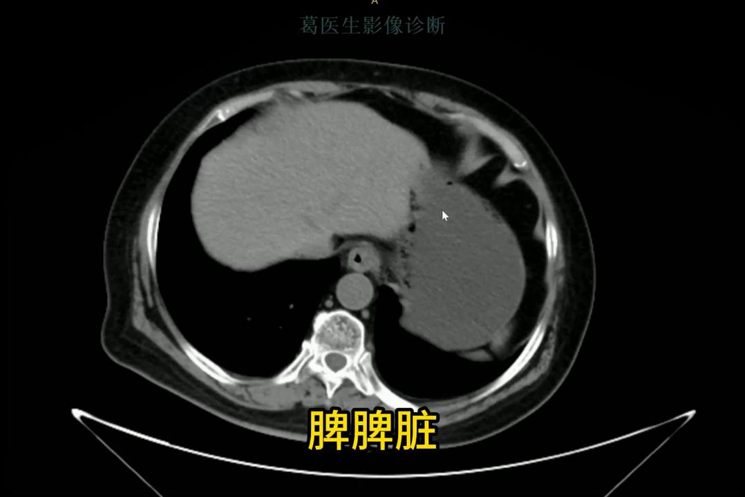 手把手教你看肺ct片,手把手带你看ct腹部