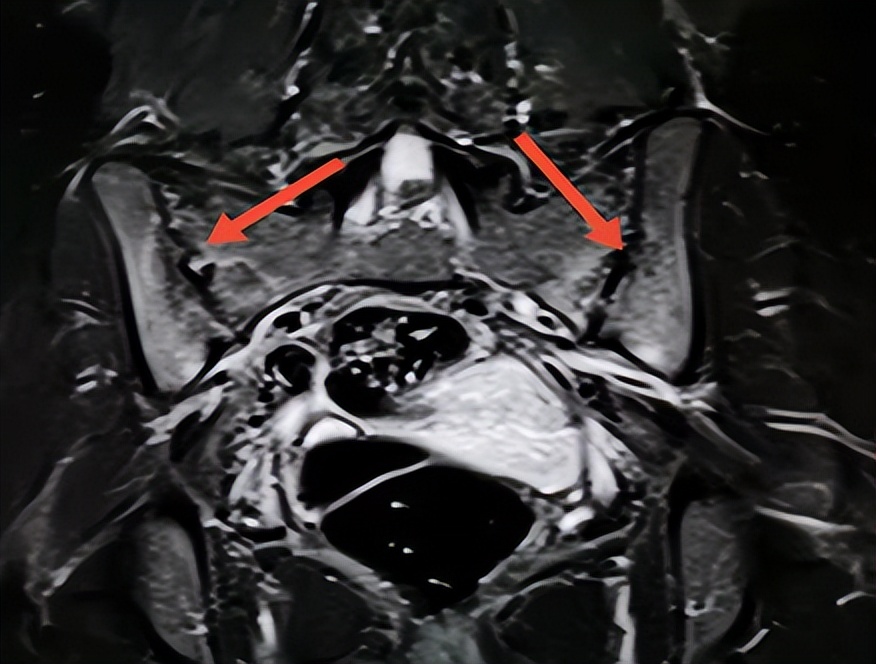 如何判断自己是腰肌劳损还是强直,腰腿疼痛是不是跟腰肌劳损有关系