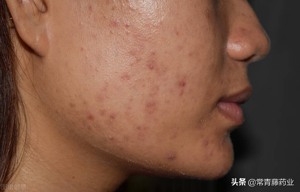 红痘印黑痘印如何快速解决,痘印留下黑斑怎么去除