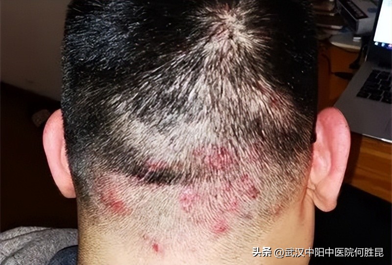 脖子后面长了个硬包有脓怎么回事