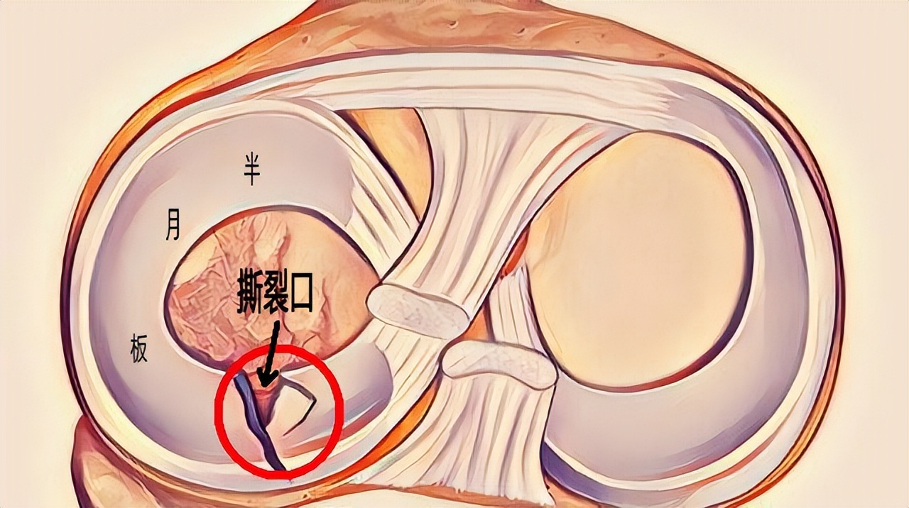 半月板损伤严重的状态是什么,半月板损伤应该注意什么问题