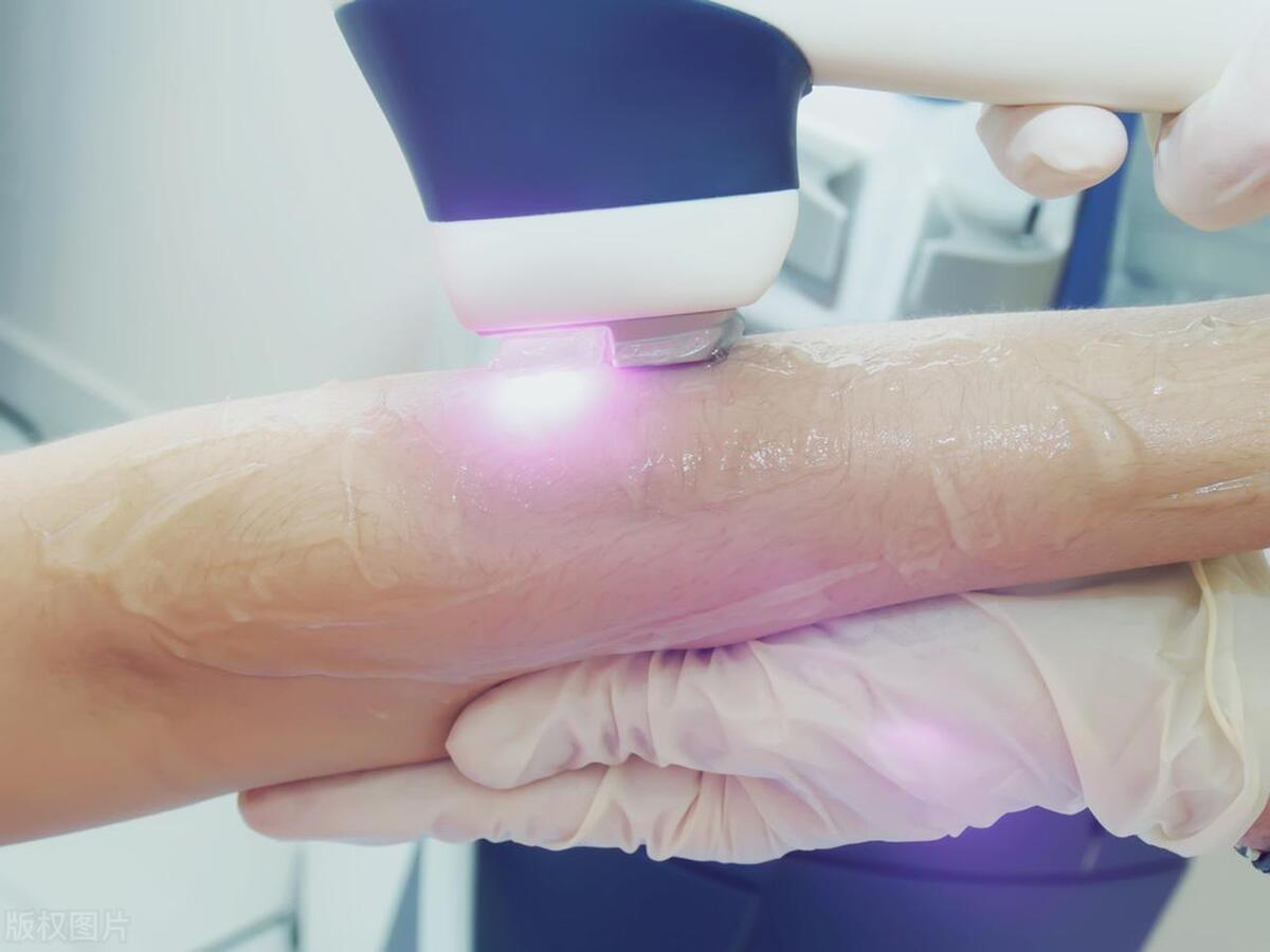 激光脱毛几次有效果,激光脱毛对白毛有作用吗