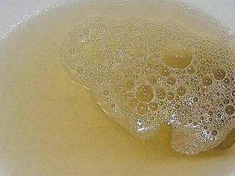 小便时泡沫多，除了肾不好，还可能与这3个原因有关，需了解