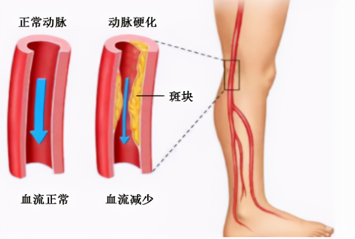 冬天脚冷可以直接截肢吗,脚越泡越冷还能继续泡吗