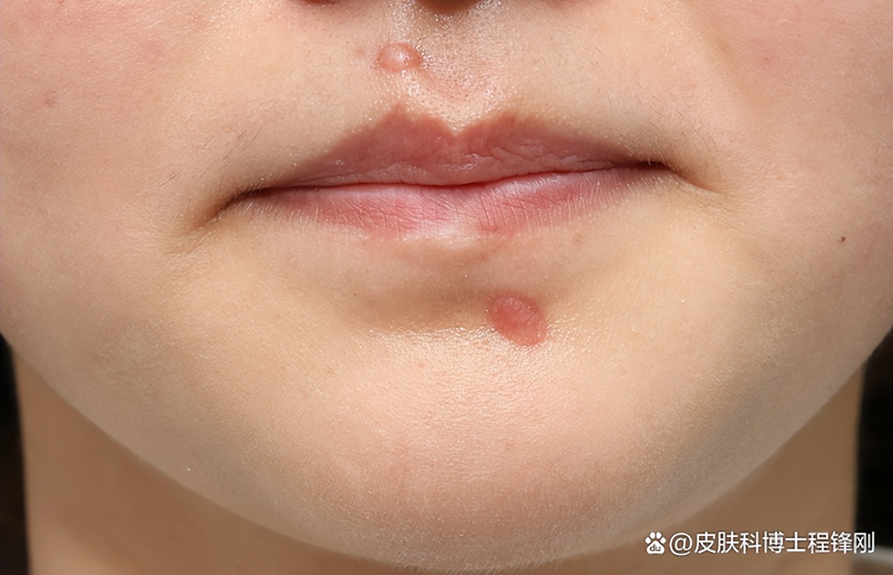 祛痣了怎么会长出肉疙瘩,祛痣之后长出了红痘还能好吗