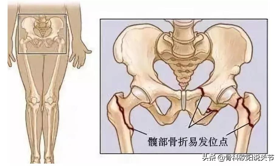 为什么说髋部骨折是最后一次骨折,股骨颈骨折为什么是最后一次骨折