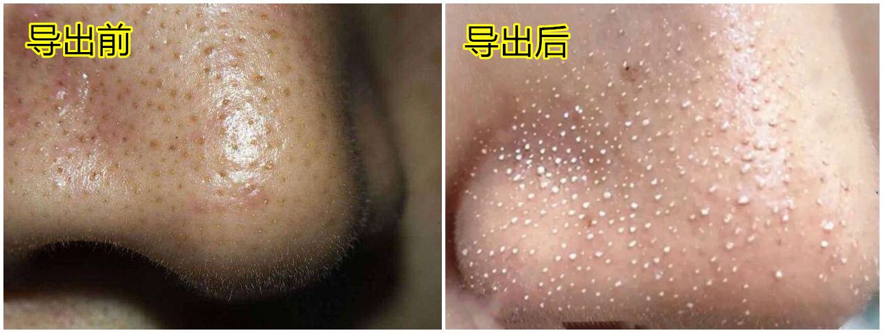 为什么鼻子可以挤出很大的黑头,用夹子挤出鼻子黑头