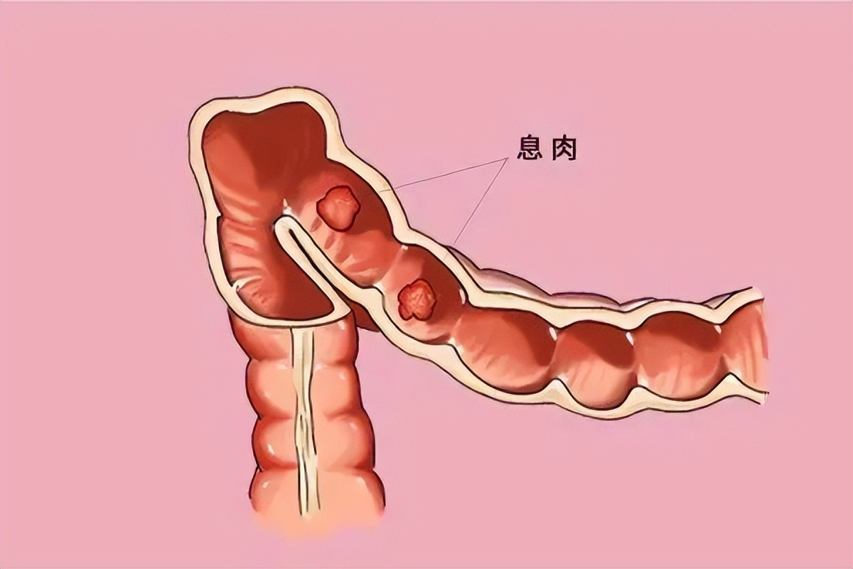 体检报告息肉没有显示大小吗,结肠息肉0.4切除后还会癌变吗