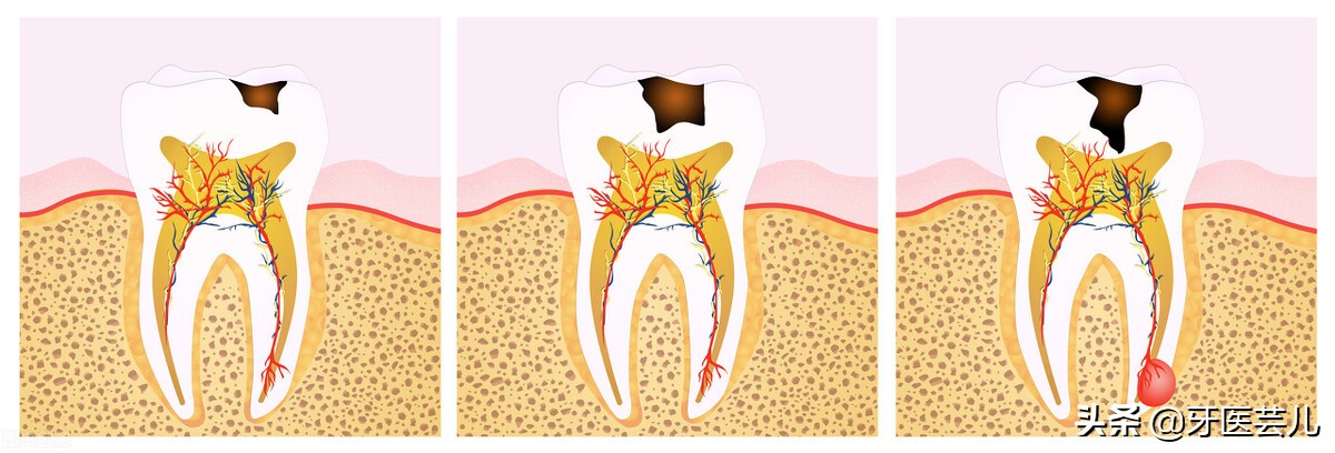 牙龈被牙医磨了一直出血,牙龈出血怎么办有什么好方法吗