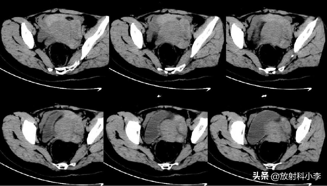 妇科急腹症的ct表现,妇科急腹症的诊断与治疗