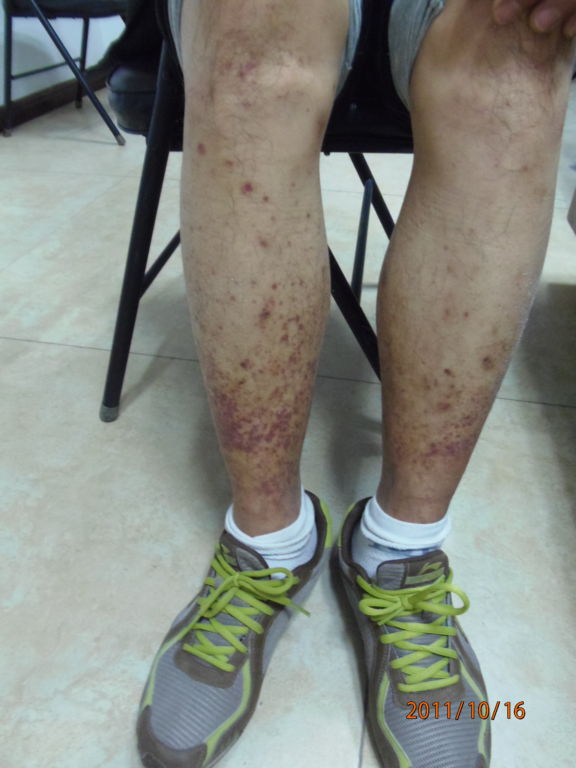 过敏性紫癜小腿反复出现出血点,过敏性紫癜老反复起小红点怎么办