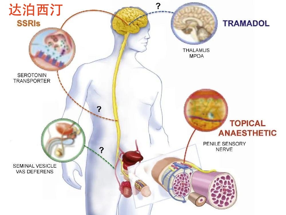 治疗*泄早**的达泊西汀，服用后为什么会无效呢？