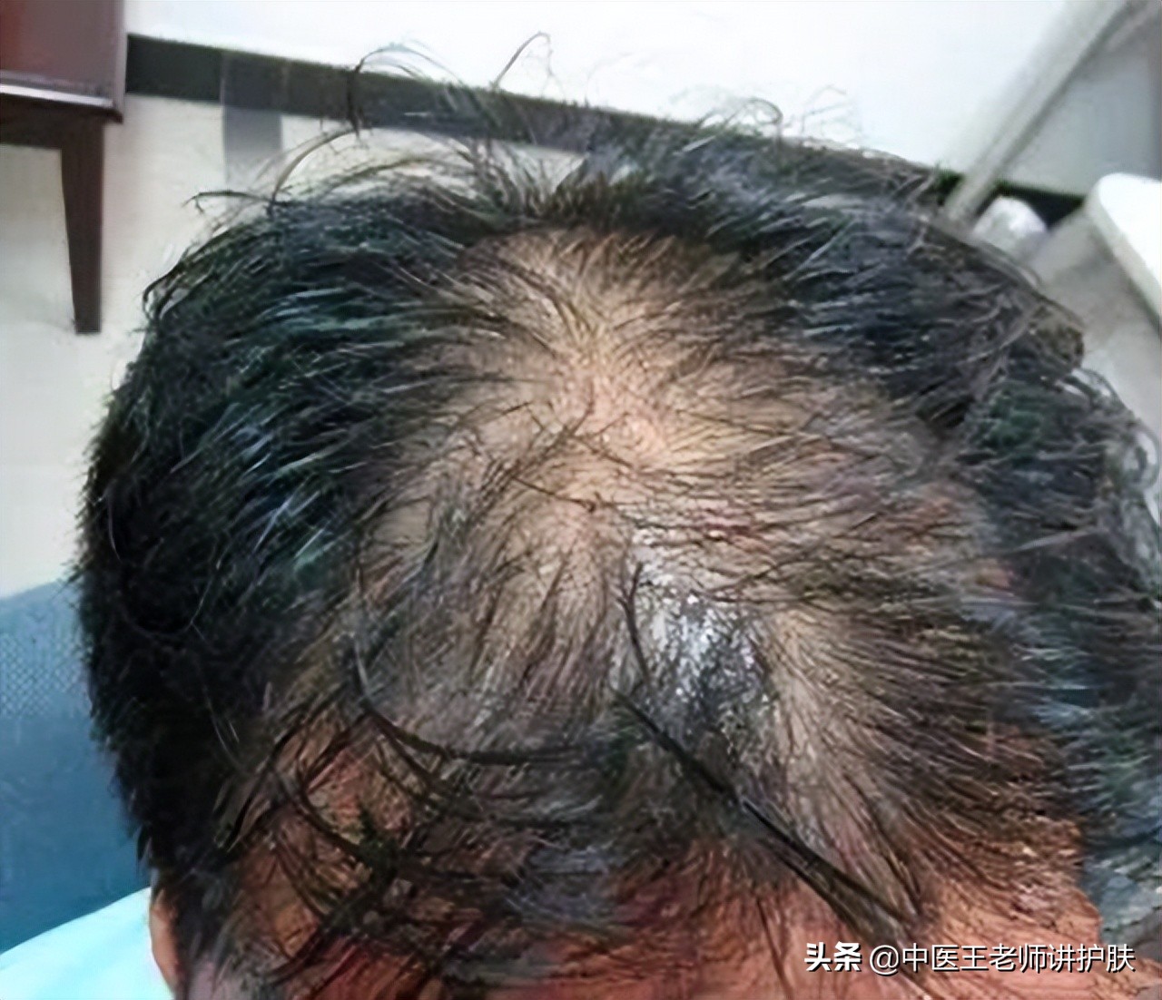 脱发与五脏的关系,引起脱发的四个习惯