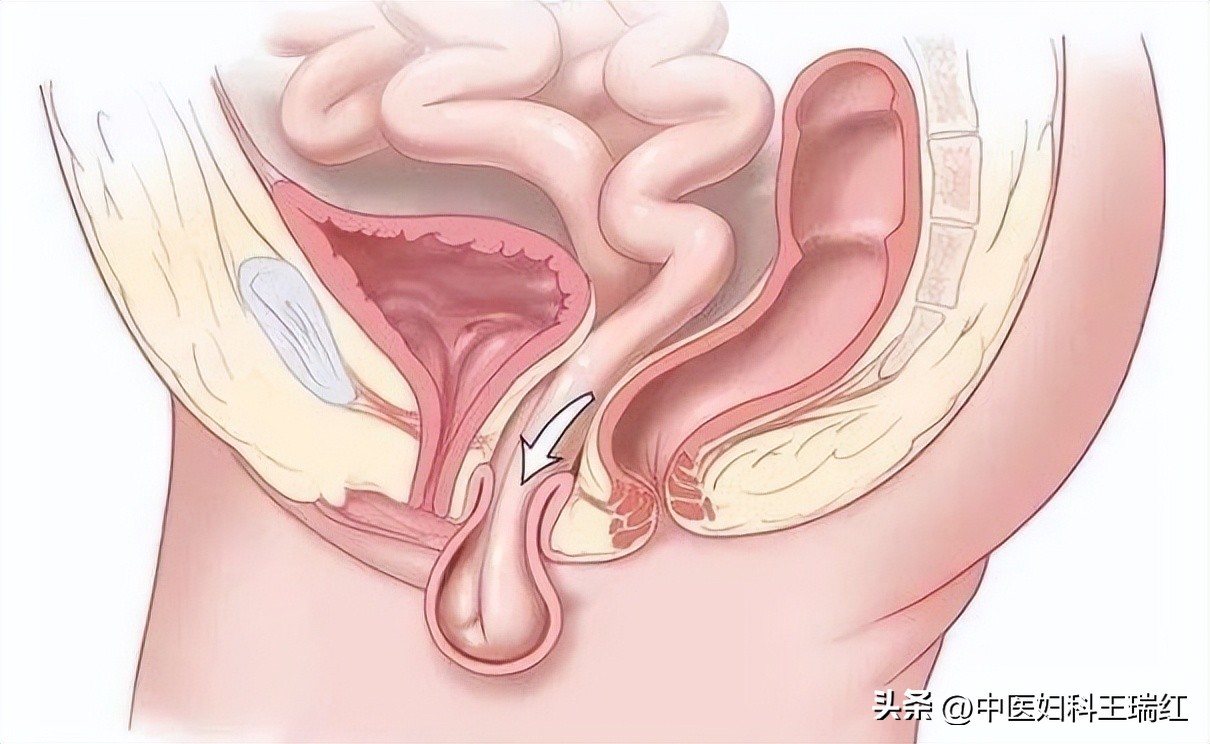 总感觉阴道口有东西掉出来？子宫脱垂了解一下
