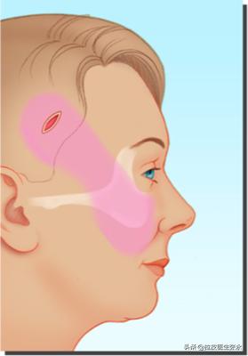 内窥镜拉皮除皱,拉皮和内窥镜拉皮哪一个好
