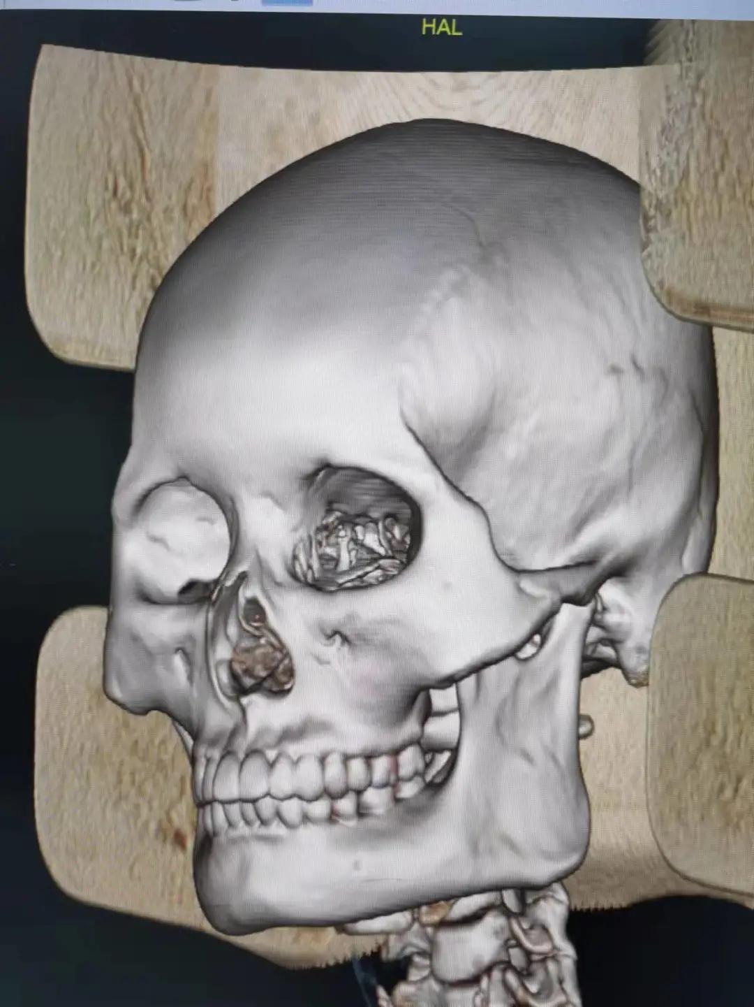 下颌角比较突出怎么改善,下颌问题是什么