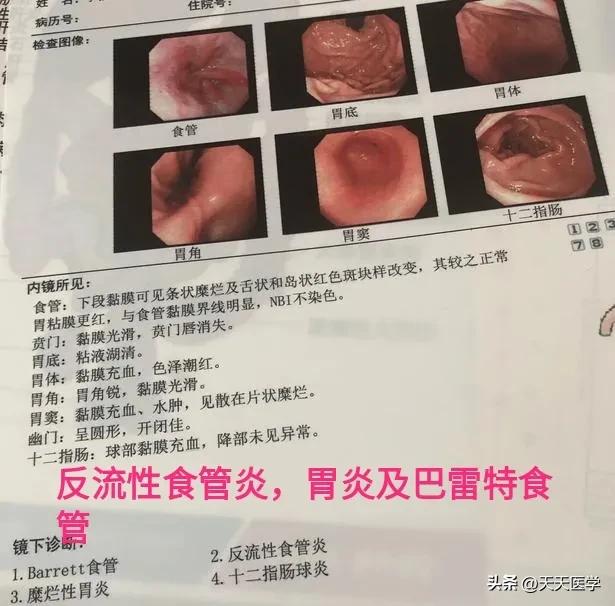 长期胃病患者多久一次胃镜检查,胃病患者多长时间做一次胃镜检查