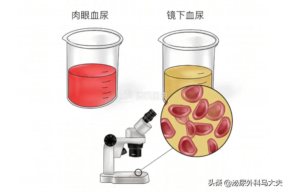 尿血就一定是癌症前兆吗？医生：不谈血色变，也不掉以轻心