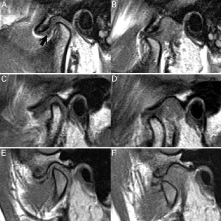 颞下颌关节紊乱核磁共振全过程,颞下颌关节磁共振怎么看图像