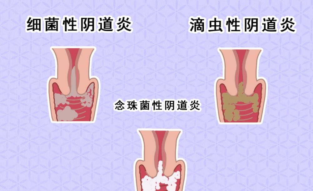 外阴特别肥大怎么回事,女生阴道有什么症状要注意身体