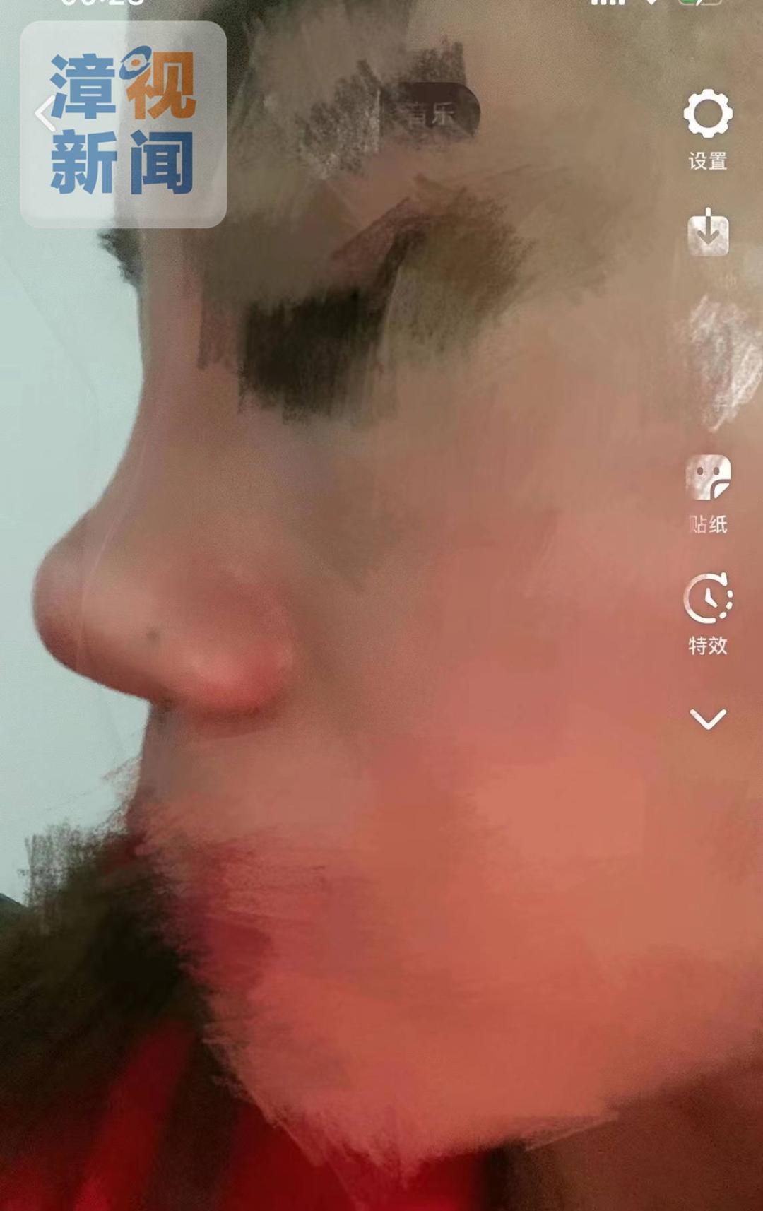 消费提醒|整容后,漳州一女子鼻子竟“动来动去”……