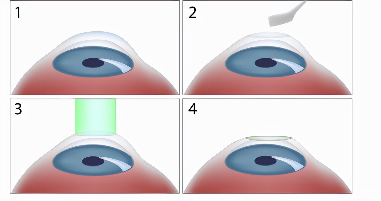 角膜激光手术矫正近视要多少钱,近视激光矫正手术的弊端与危害