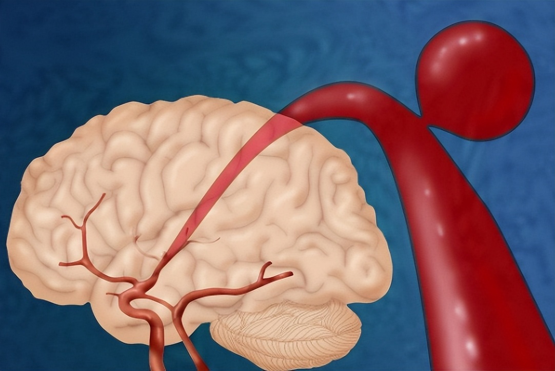 民间土方治疗脑中风,脑中风是什么原因和征兆