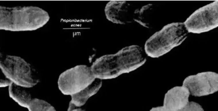 战痘全攻略4种痘痘的祛痘秘诀,痘痘交流必看祛痘方法