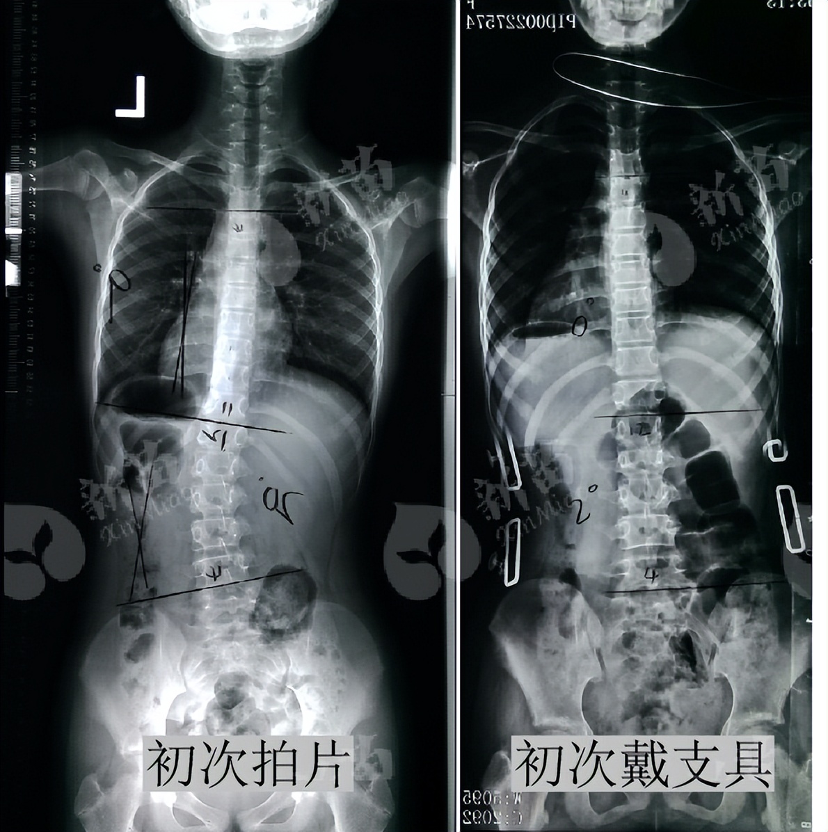 12岁女孩矫正脊柱侧弯,女孩侧弯矫正锻炼