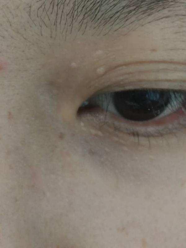 脖子上长的小肉粒可以揪掉吗,脖子和腋下的小肉粒可以揪掉吗