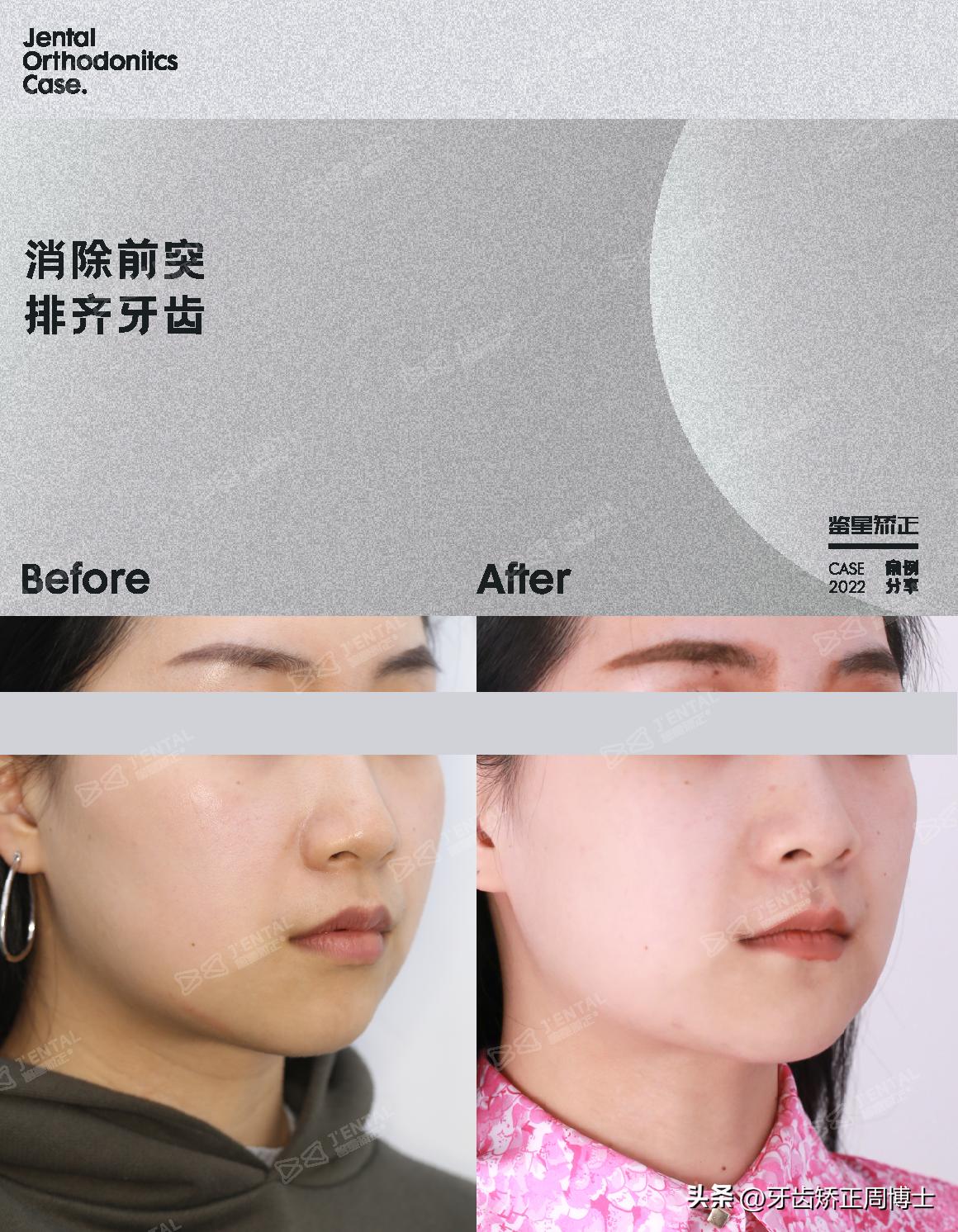 即刻种植即刻修复免受缺牙的痛苦,缺牙不补倾斜矫正价钱