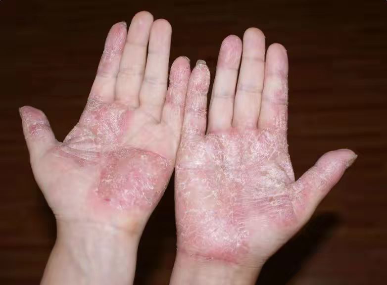 湿疹汗疱疹与水疱型手癣区别,汗疱疹湿疹的根治方法
