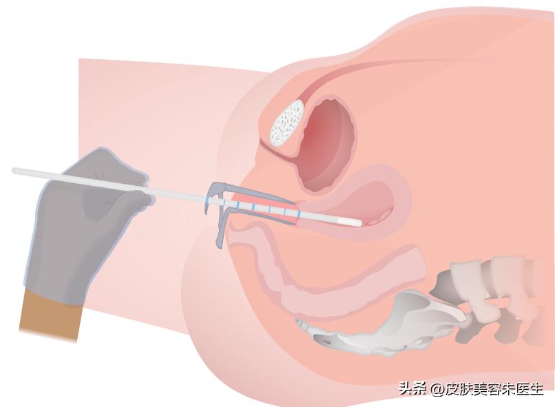 醋酸白试验一定是湿疣吗,醋酸白试验可能是假性湿疣吗