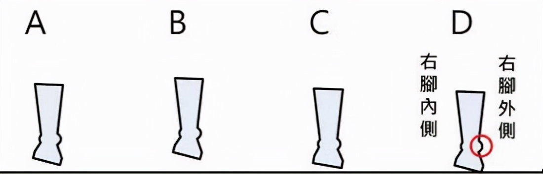 足内翻原因及治疗,足内翻足外翻怎么引起的
