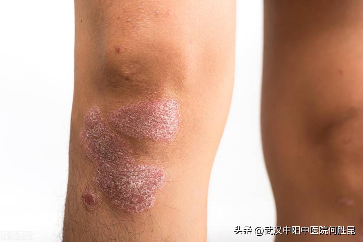 脚上起湿疹特别痒吃什么药,腿上湿疹引起皮肤变黑