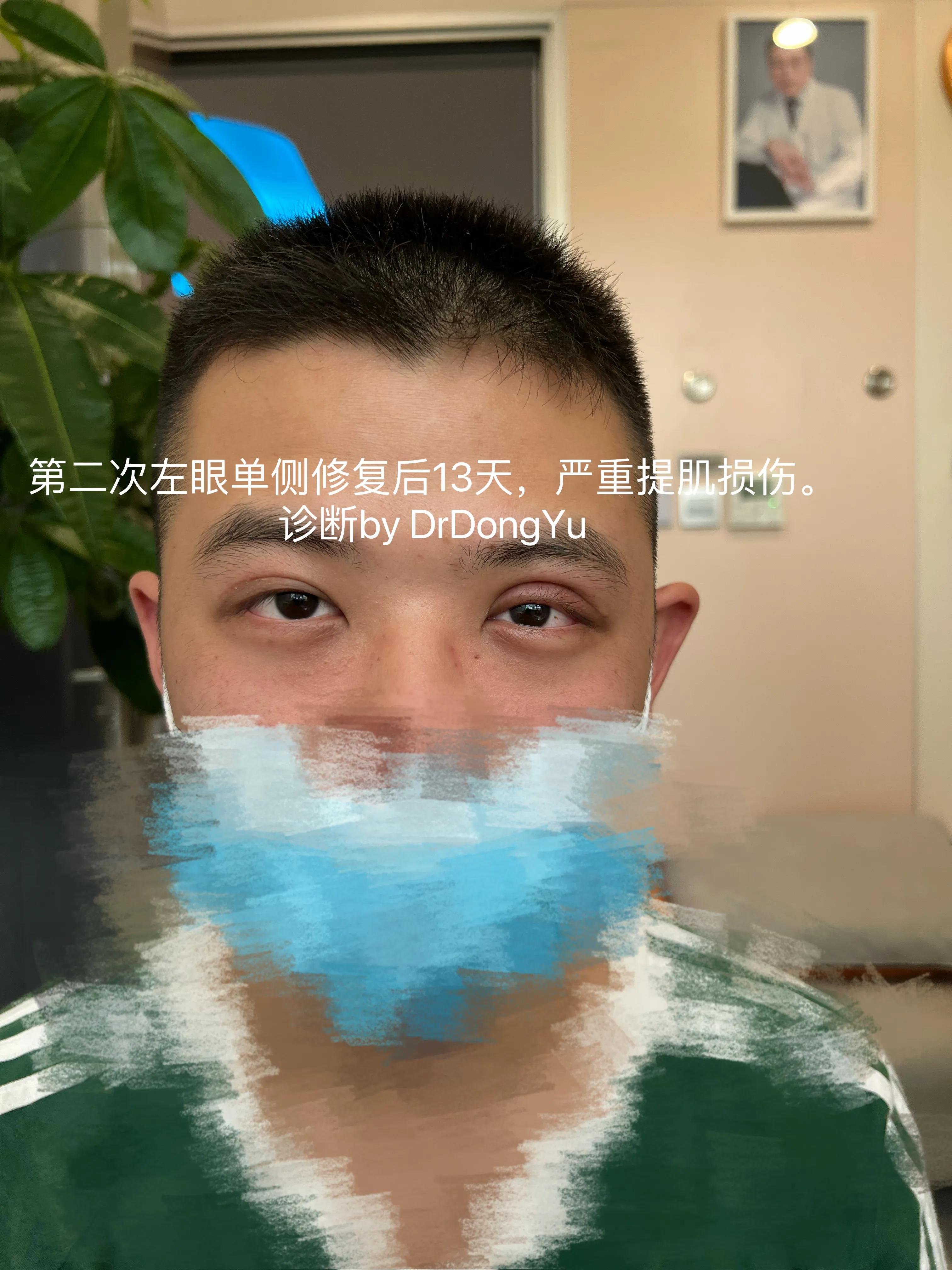 提肌手术多长时间能恢复,严重受损发质修复