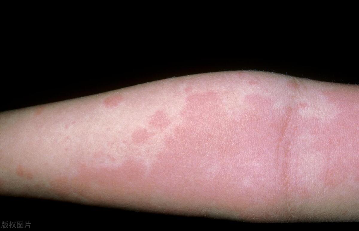 睡觉一热皮肤就特别痒口服什么药,睡觉一热皮肤痒怎么回事