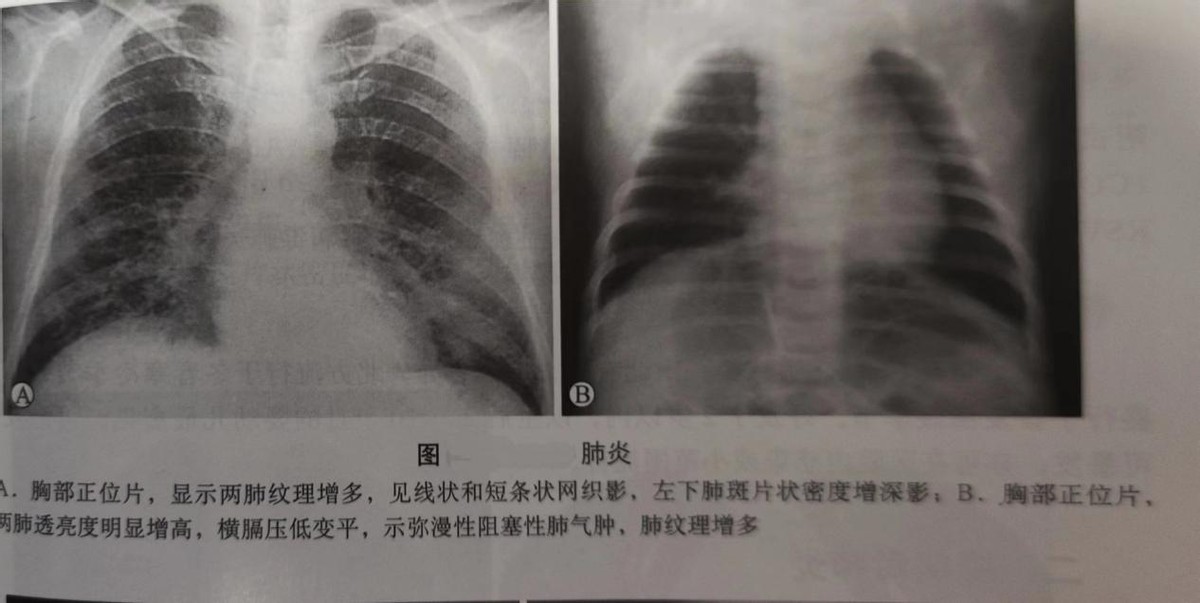 24天宝宝得肺炎怎么治疗最好,儿科肺炎用药进口头孢