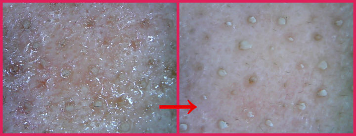 清洁面膜可以去黑头粉刺闭口吗,清洁面膜可以去除黑头吗