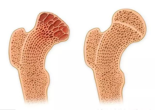 骨头对于人体来说是非常重要的,如果人体没有骨头会怎么样
