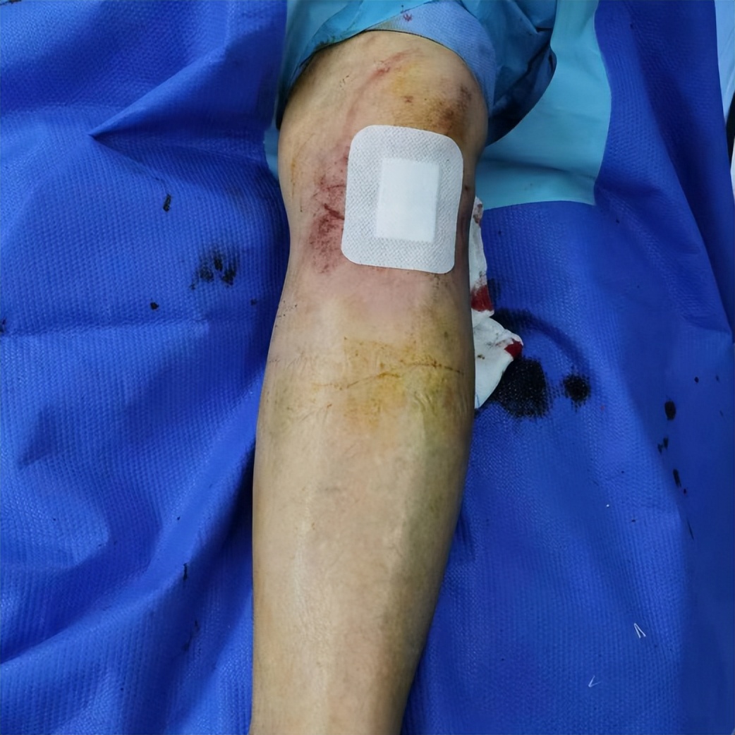 怎么做才能快速治愈膝关节炎,治疗膝骨关节炎最新技术