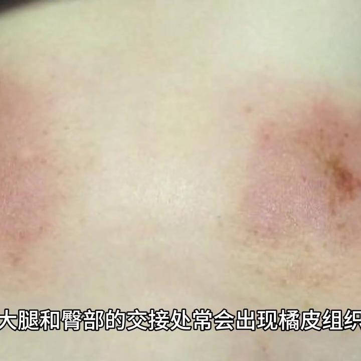 艾灸瘦小腿最有效的方法,艾灸如何让腿瘦下来