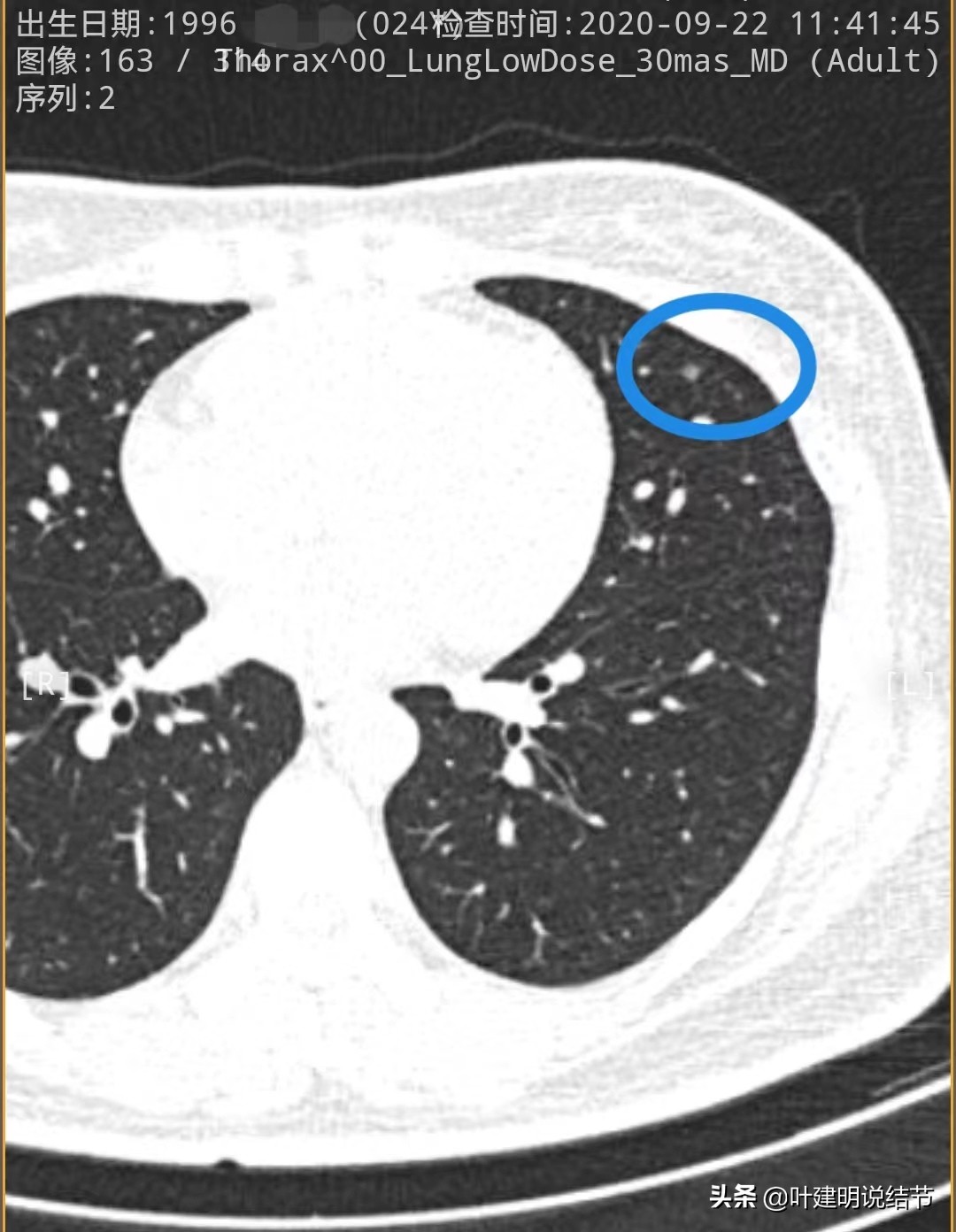 27岁女博士查出肺癌,年轻人多发肺结节怎么治愈