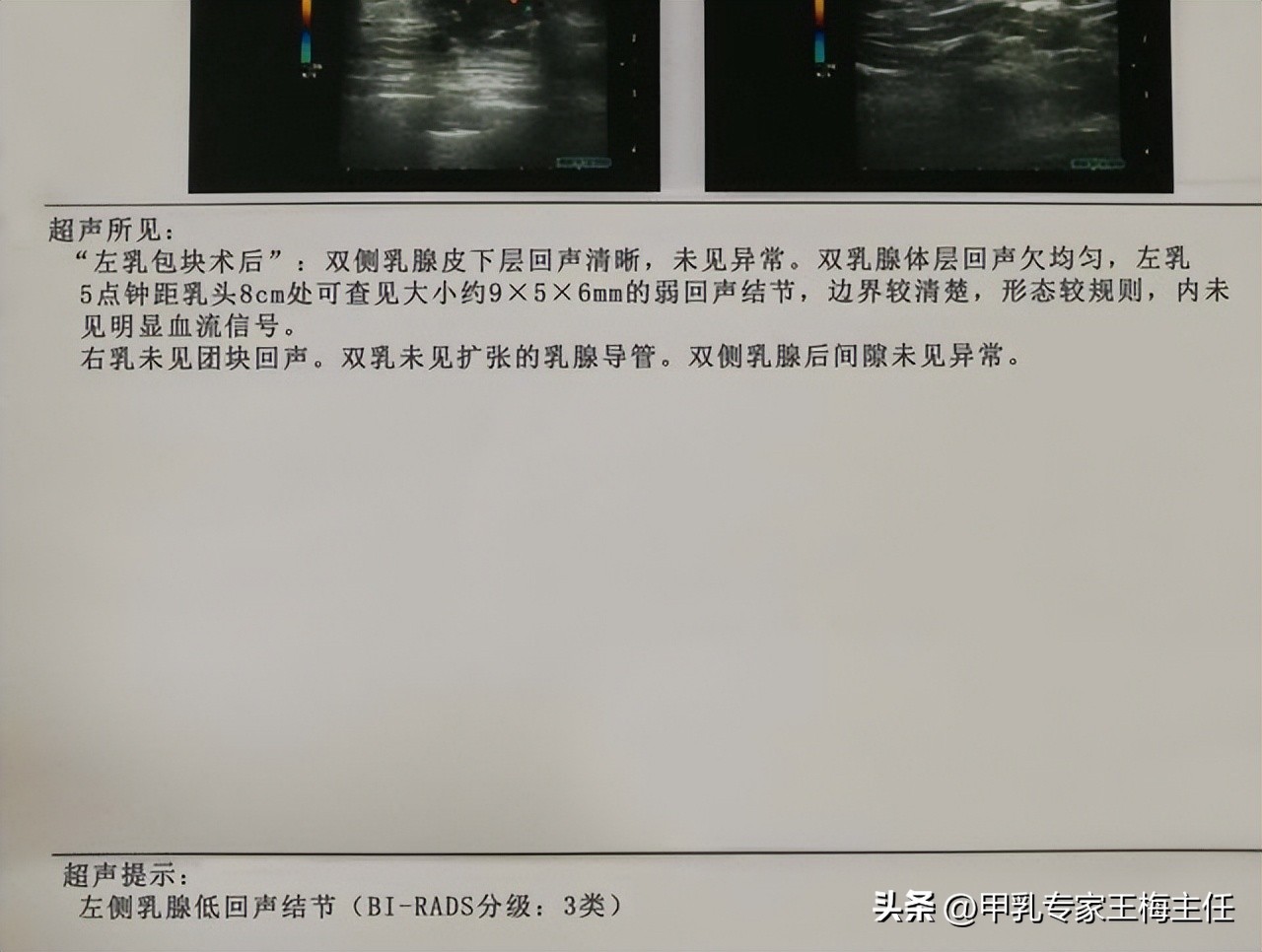 张仲景治疗乳腺结节经方,治乳腺结节的中药一天喝几次