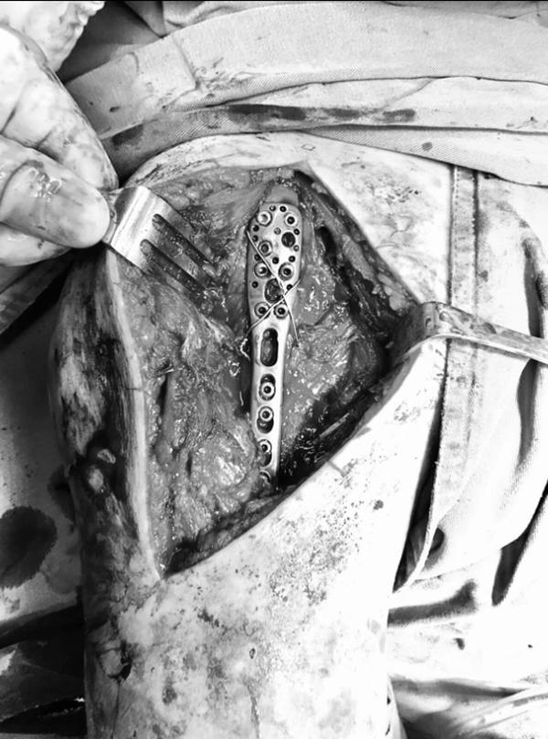 肱骨近端骨折属于几级伤残,肱骨近端骨折康复训练技巧