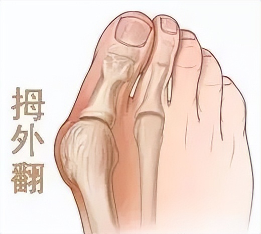 拇外翻的5种解决方法,拇外翻做什么动作缓解