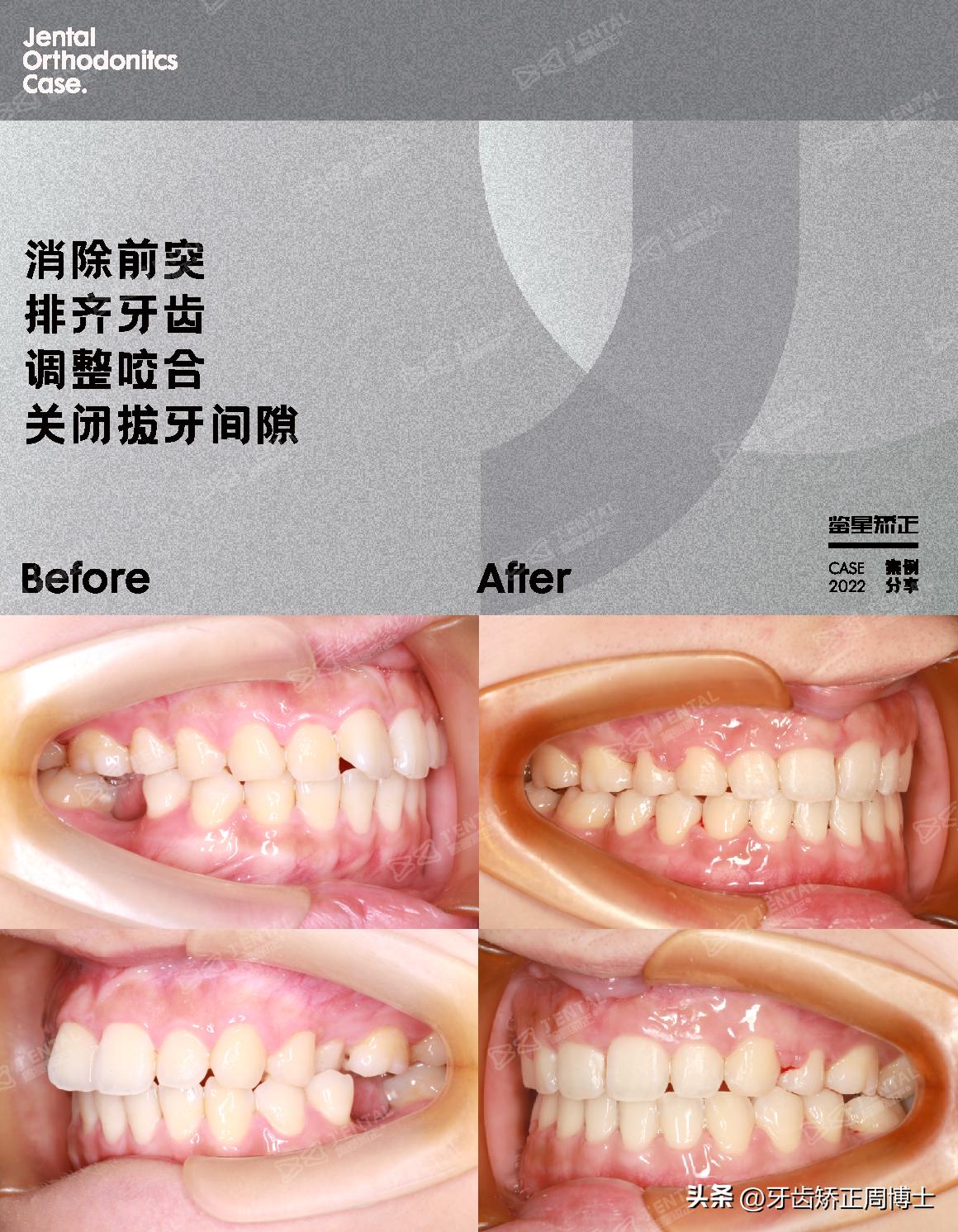 即刻种植即刻修复免受缺牙的痛苦,缺牙不补倾斜矫正价钱