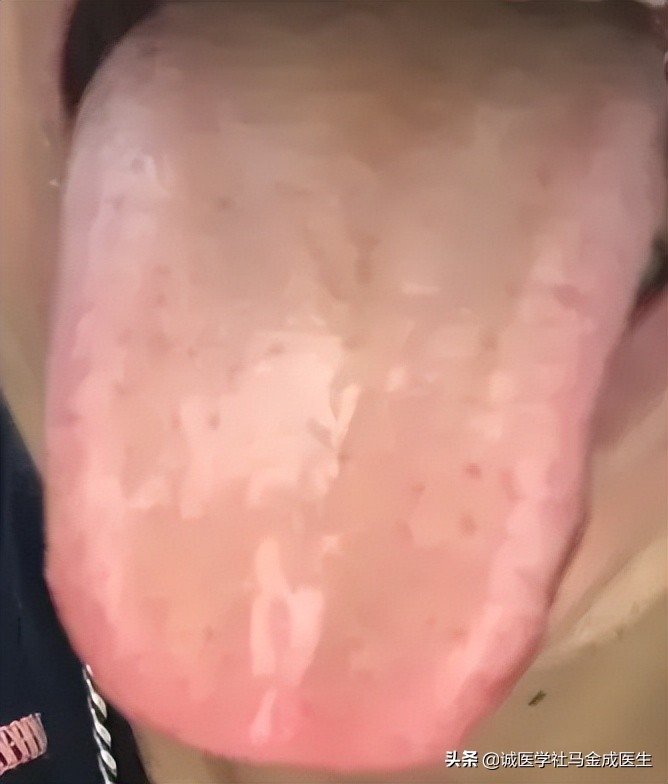 胃火旺会容易饿是实火还是虚火,脾胃湿热去胃火吃什么中成药