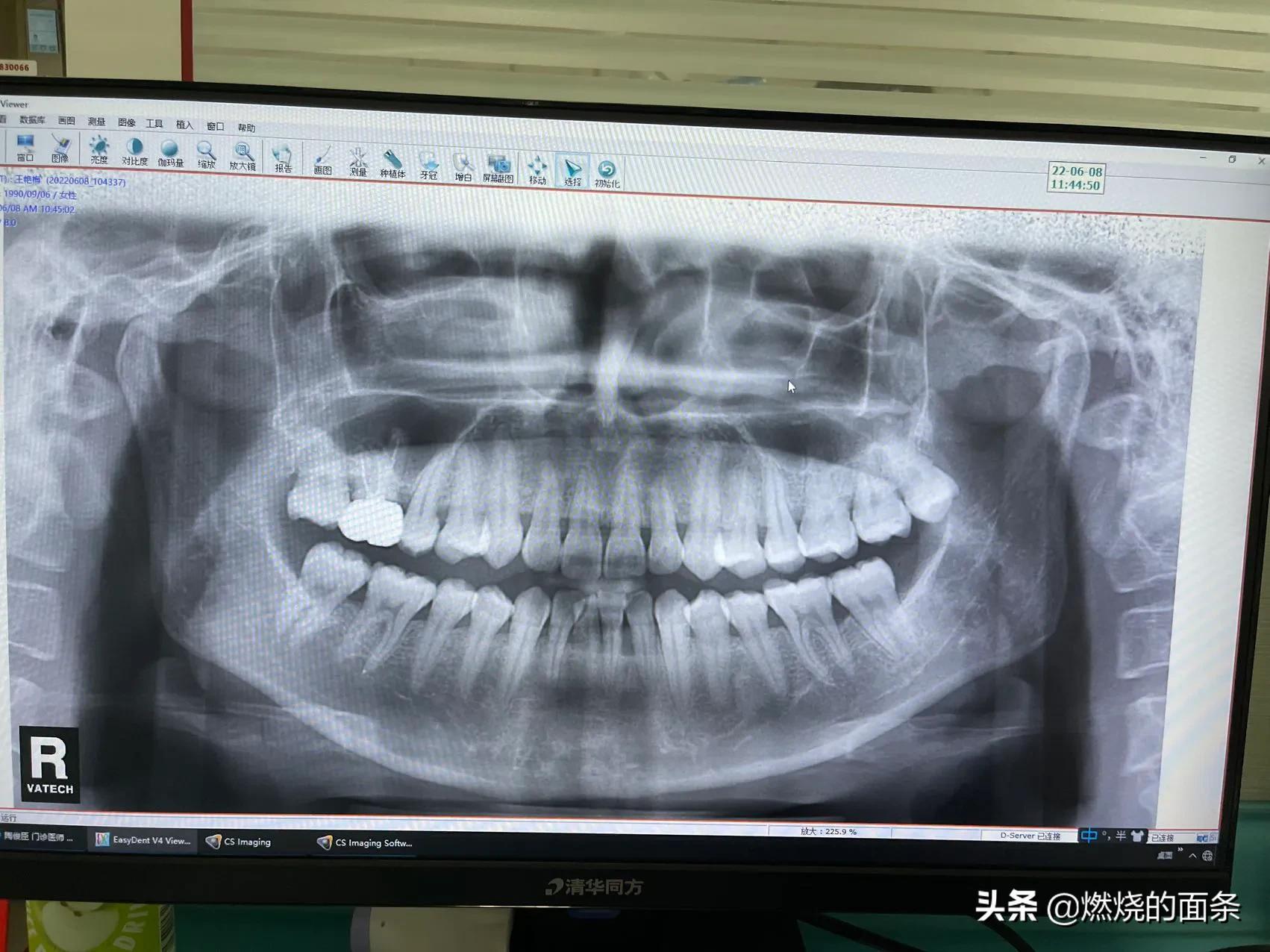 拔智齿选择医院拔还是门诊,拔智齿为什么要去公立医院